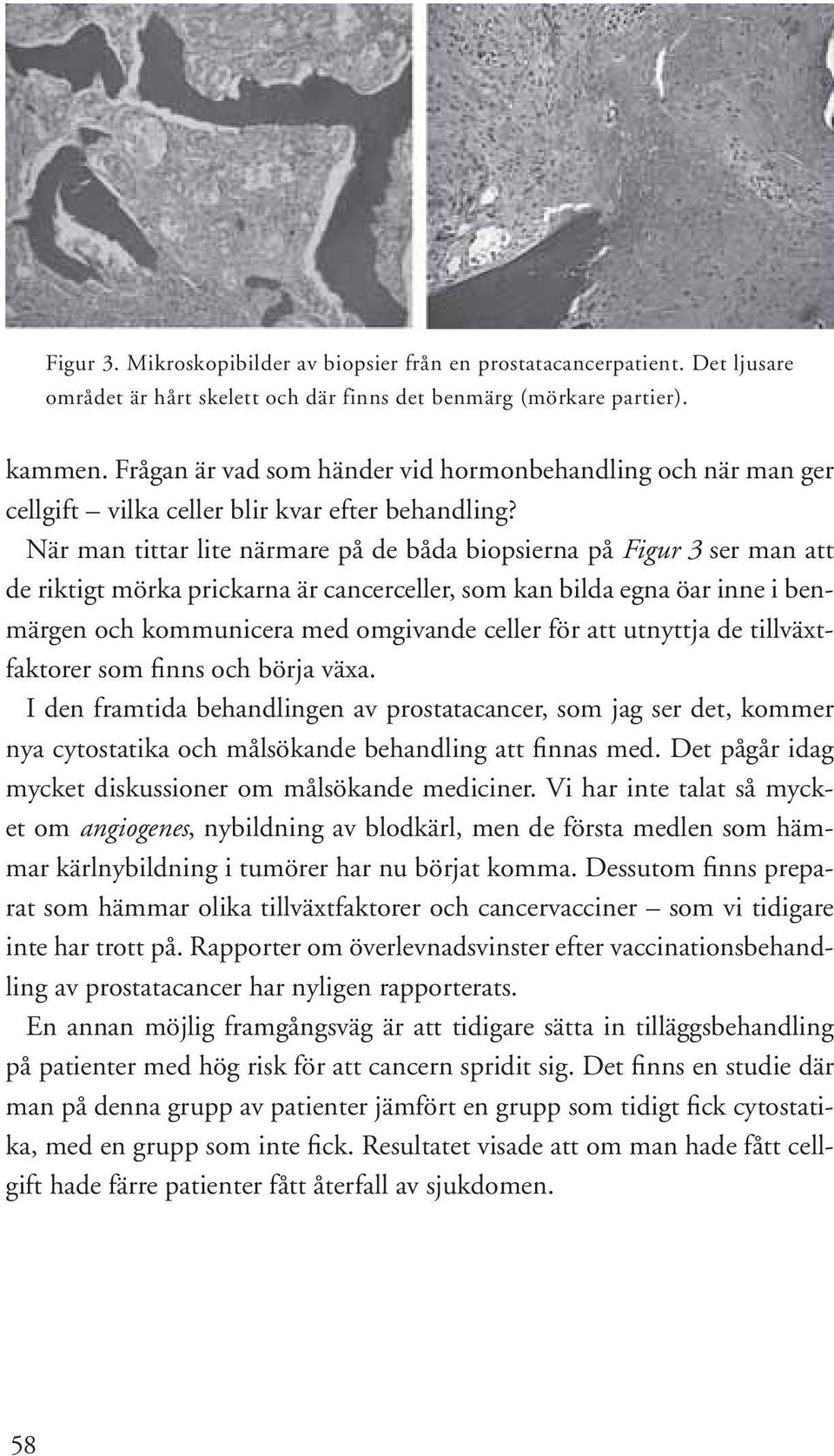 När man tittar lite närmare på de båda biopsierna på Figur 3 ser man att de riktigt mörka prickarna är cancerceller, som kan bilda egna öar inne i benmärgen och kommunicera med omgivande celler för