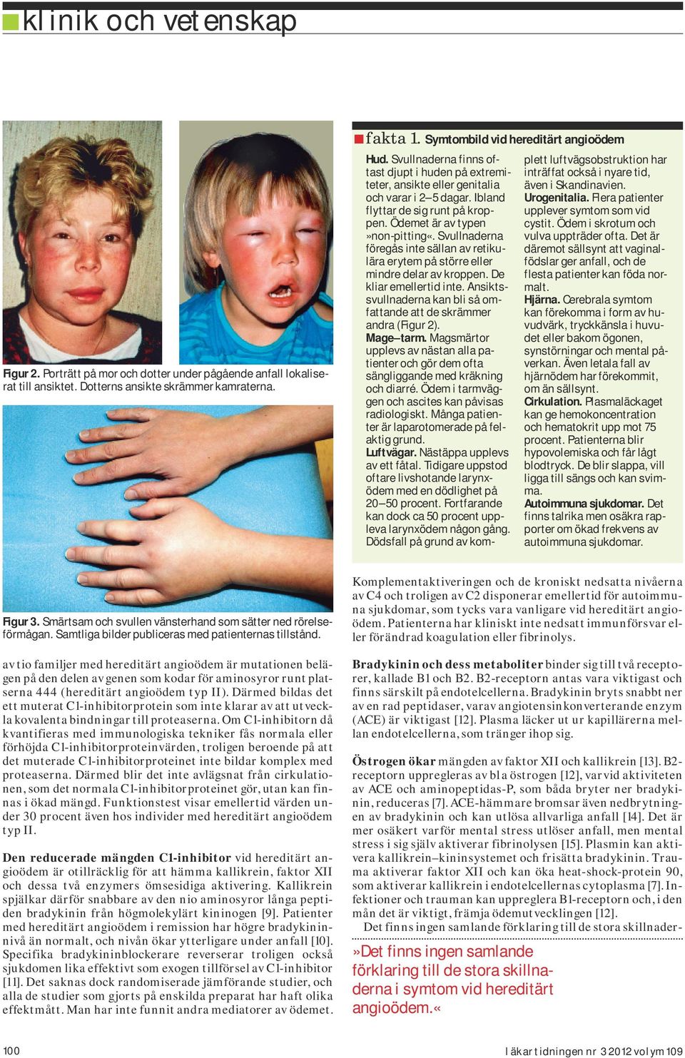 Svullnaderna föregås inte sällan av retikulära erytem på större eller mindre delar av kroppen. De kliar emellertid inte. Ansiktssvullnaderna kan bli så omfattande att de skrämmer andra (Figur 2).