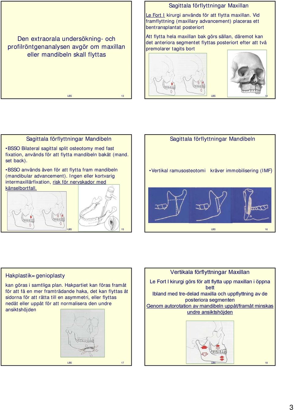 premolarer tagits bort 13 14 Sagittala förflyttningar Mandibeln BSSO Bilateral sagittal split osteotomy med fast fixation, används för att flytta mandibeln bakåt (mand. set back).