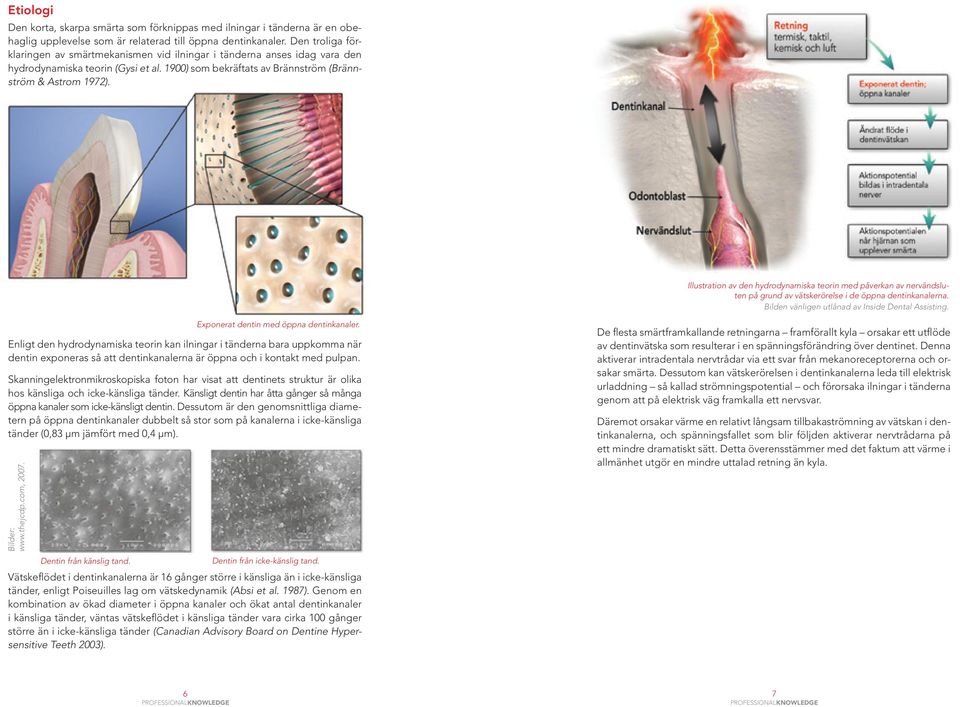 Illustration av den hydrodynamiska teorin med påverkan av nervändsluten på grund av vätskerörelse i de öppna dentinkanalerna. Bilden vänligen utlånad av Inside Dental Assisting.