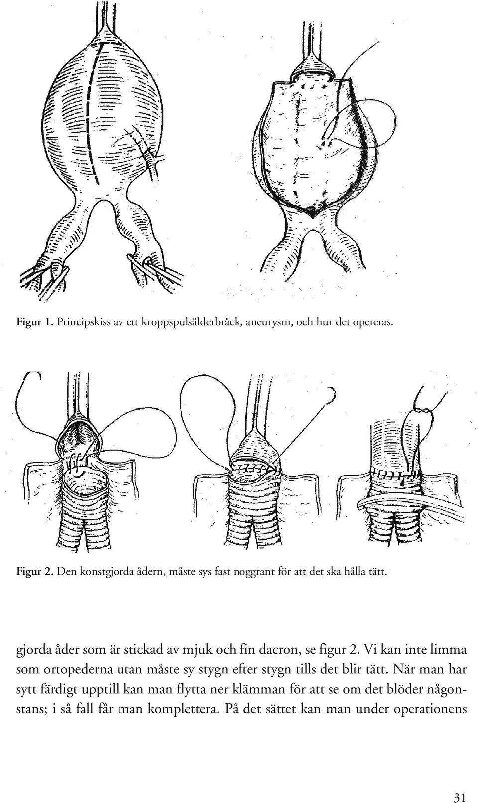 gjorda åder som är stickad av mjuk och fin dacron, se figur 2.