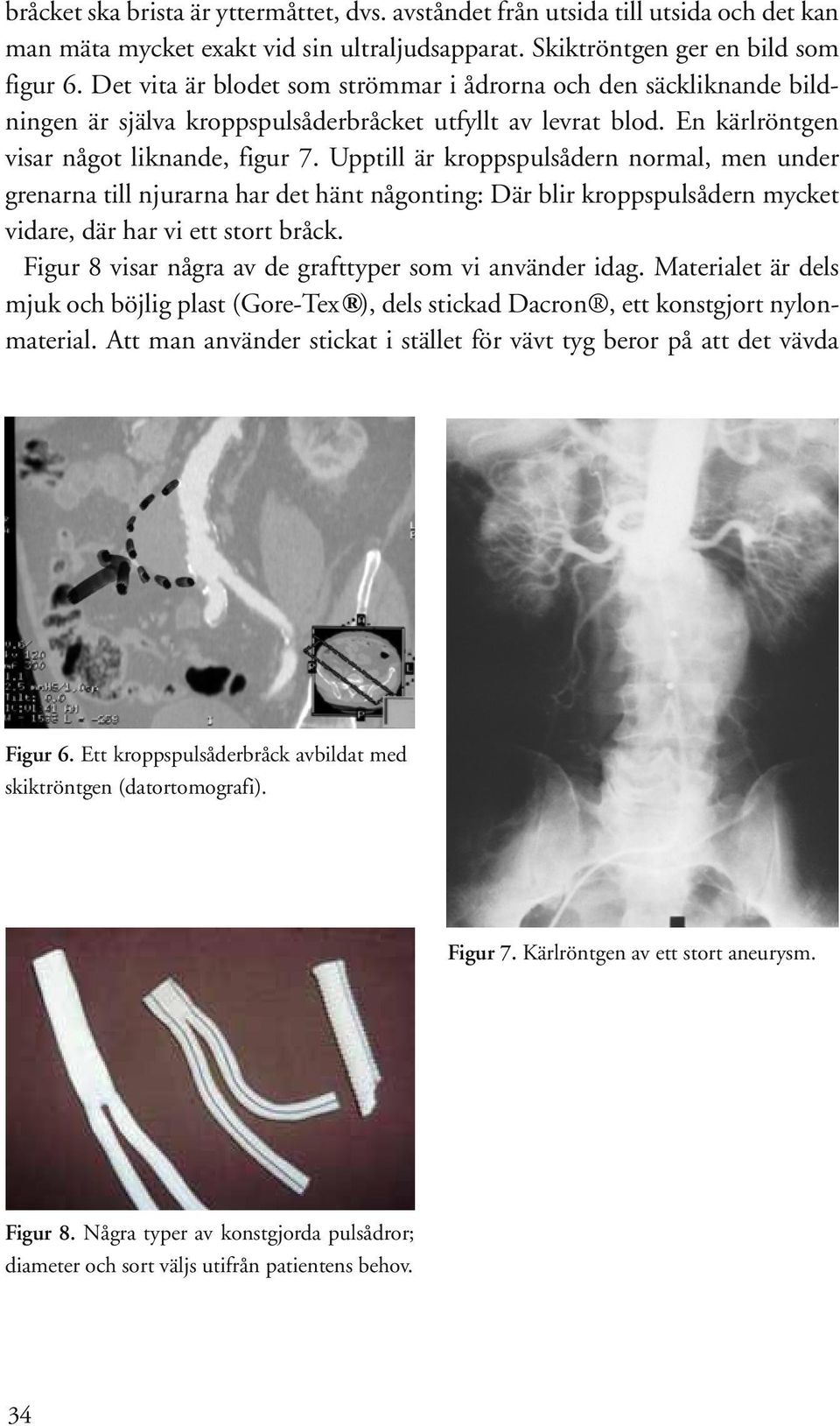 Upptill är kroppspulsådern normal, men under grenarna till njurarna har det hänt någonting: Där blir kroppspulsådern mycket vidare, där har vi ett stort bråck.