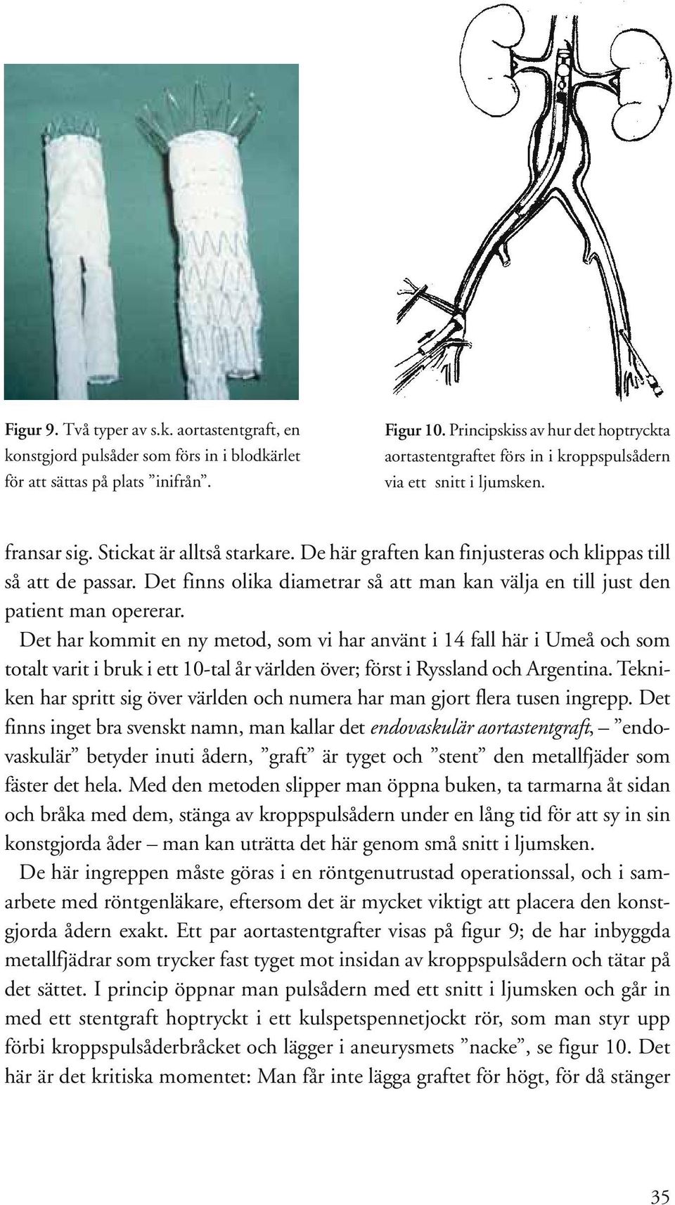 De här graften kan finjusteras och klippas till så att de passar. Det finns olika diametrar så att man kan välja en till just den patient man opererar.