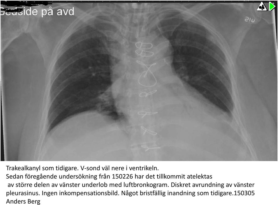 större delen av vänster underlob med luftbronkogram.