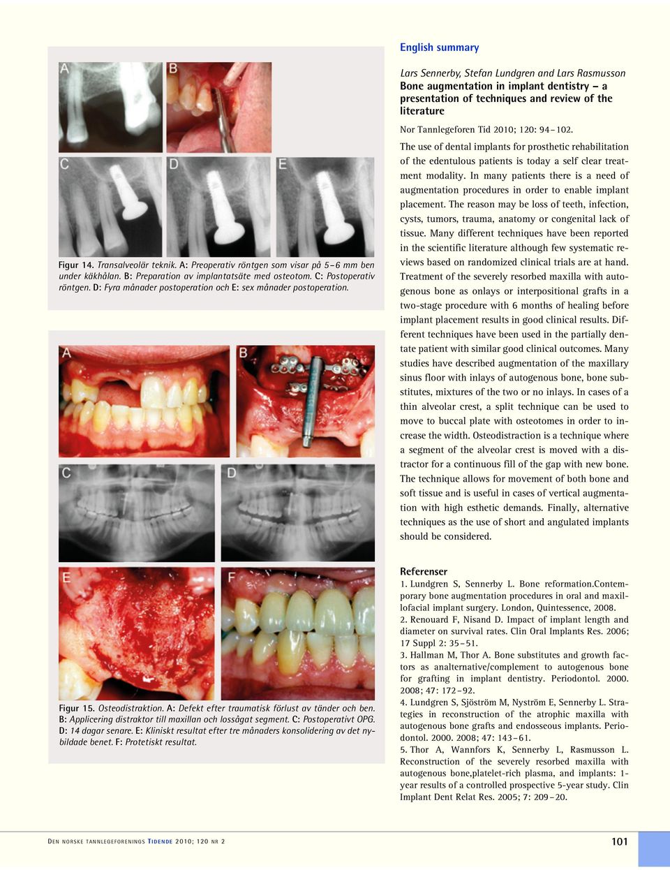 Lars Sennerby, Stefan Lundgren and Lars Rasmusson Bone augmentation in implant dentistry a presentation of techniques and review of the literature Nor Tannlegeforen Tid 2010; 120: 94 102.
