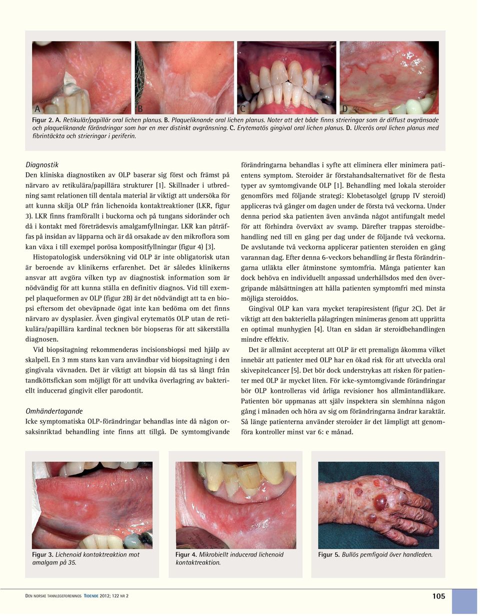 Ulcerös oral lichen planus med fibrintäckta och strieringar i periferin. Diagnostik Den kliniska diagnostiken av OLP baserar sig först och främst på närvaro av retikulära/papillära strukturer [1].