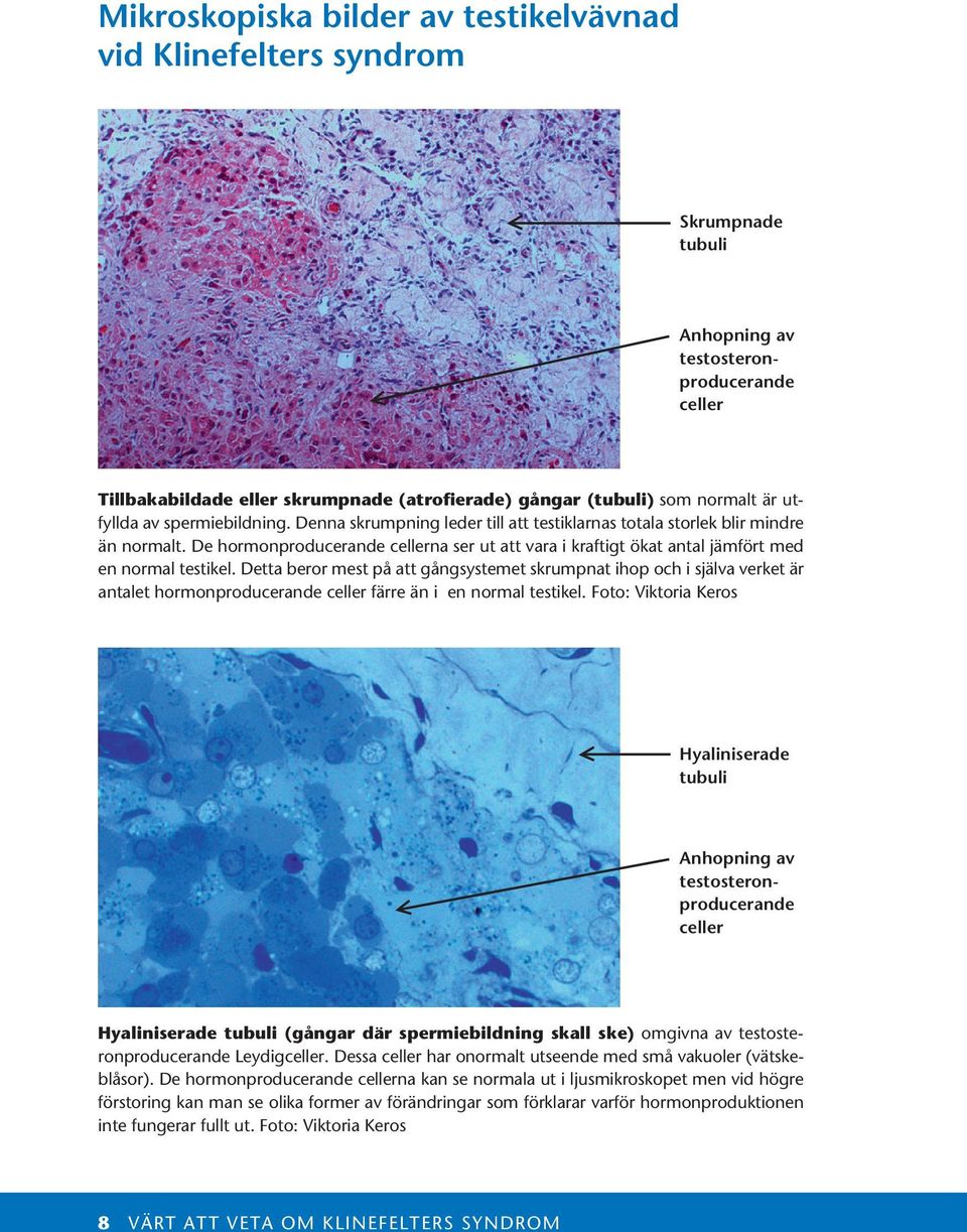 De hormonproducerande cellerna ser ut att vara i kraftigt ökat antal jämfört med en normal testikel.