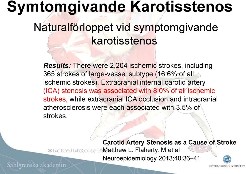 Extracranial internal carotid artery (ICA) stenosis was associated with 8.