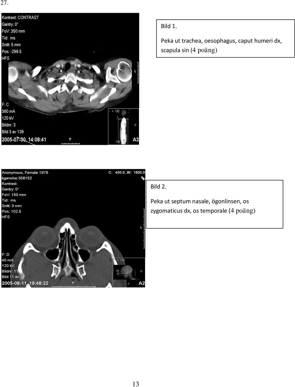 dx, scapula sin (4 poäng) Bild 2.