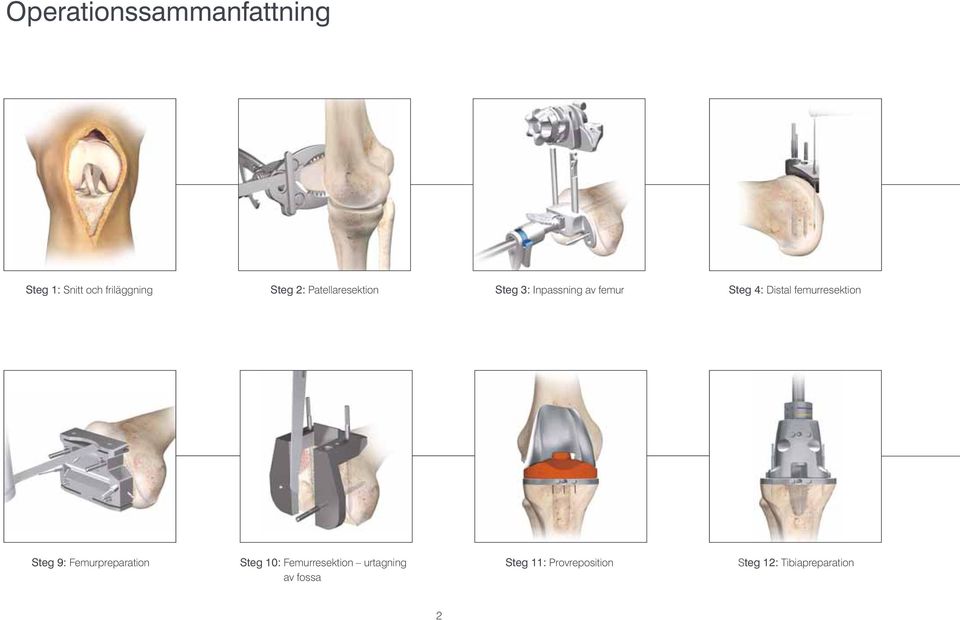 femurresektion Steg 9: Femurpreparation Steg 10: Femurresektion