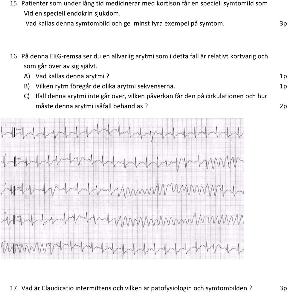 På denna EKG remsa ser du en allvarlig arytmi som i detta fall är relativt kortvarig och som går över av sig självt. A) Vad kallas denna arytmi?