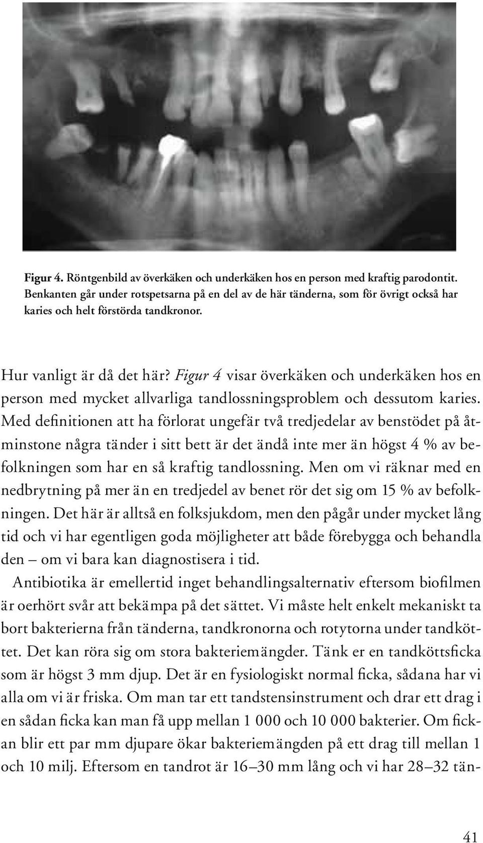 Figur 4 visar överkäken och underkäken hos en person med mycket allvarliga tandlossningsproblem och dessutom karies.