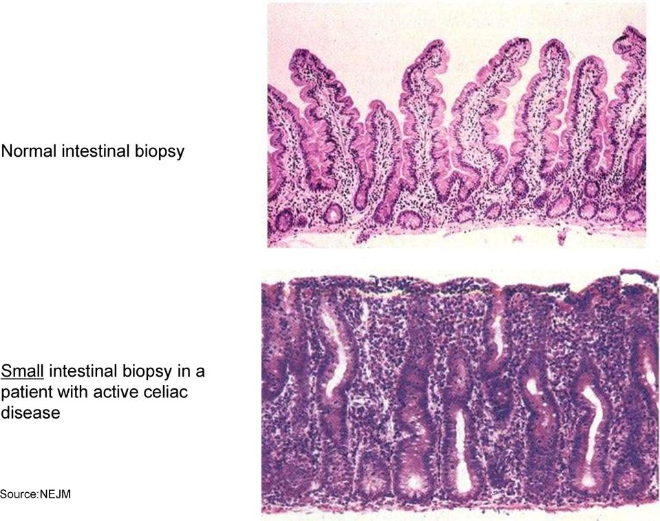 in a patient with active