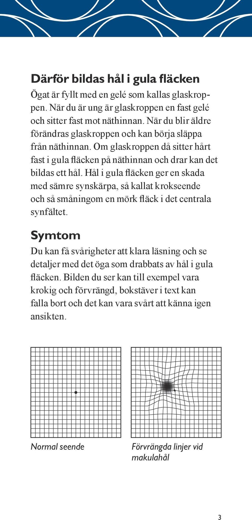 Hål i gula fläcken ger en skada med sämre synskärpa, så kallat krokseende och så småningom en mörk fläck i det centrala synfältet.