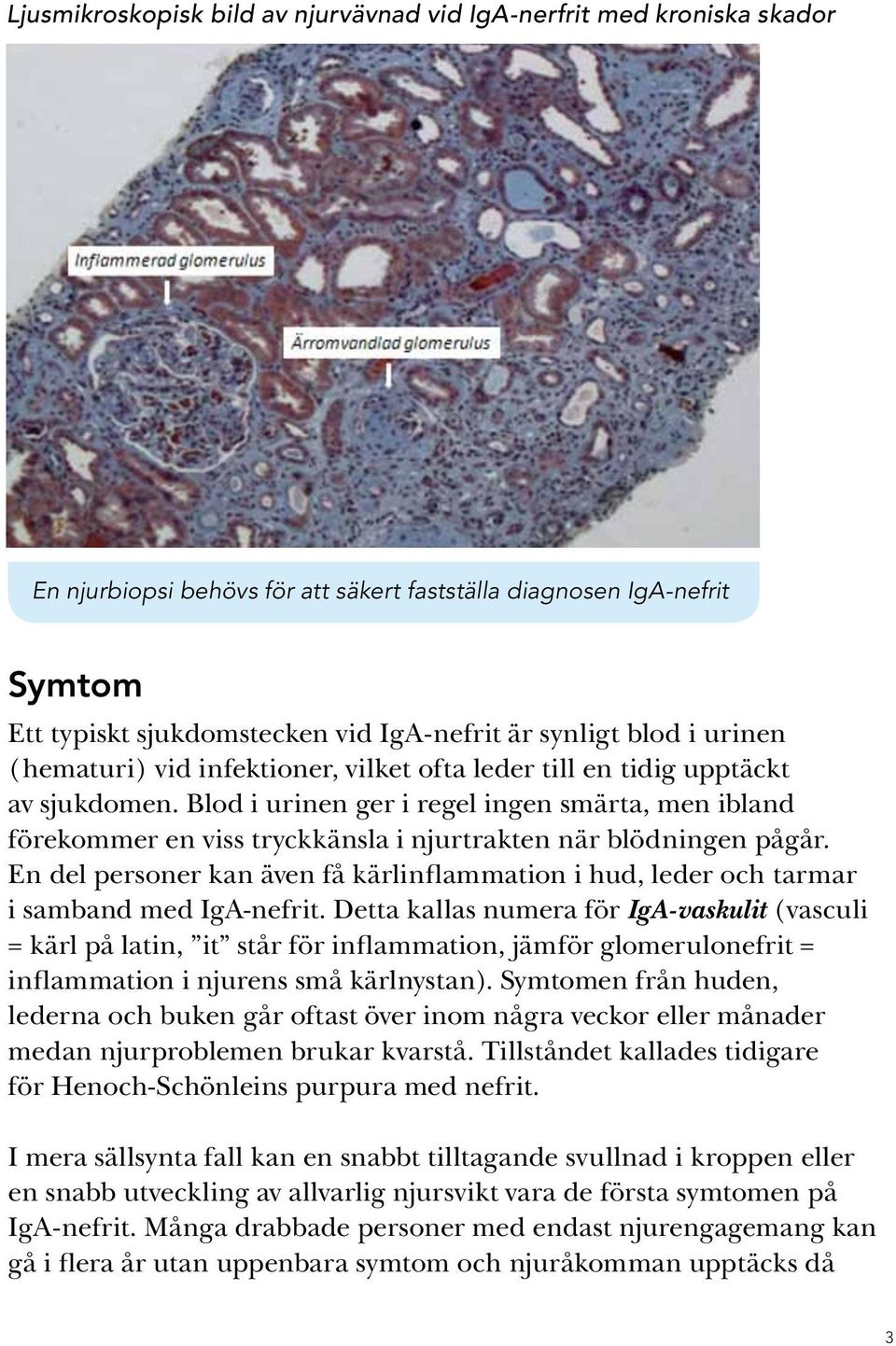 Blod i urinen ger i regel ingen smärta, men ibland förekommer en viss tryckkänsla i njurtrakten när blödningen pågår.