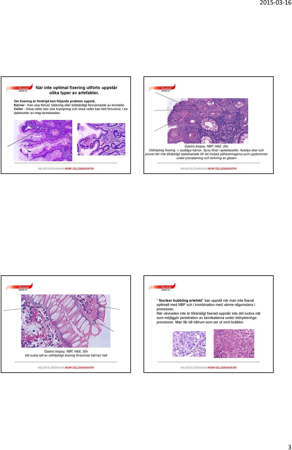 Gastric biopsy, NBF, H&E. 20x Otillräcklig fixering -> suddiga kärnor. Syns först i epitelieceller.