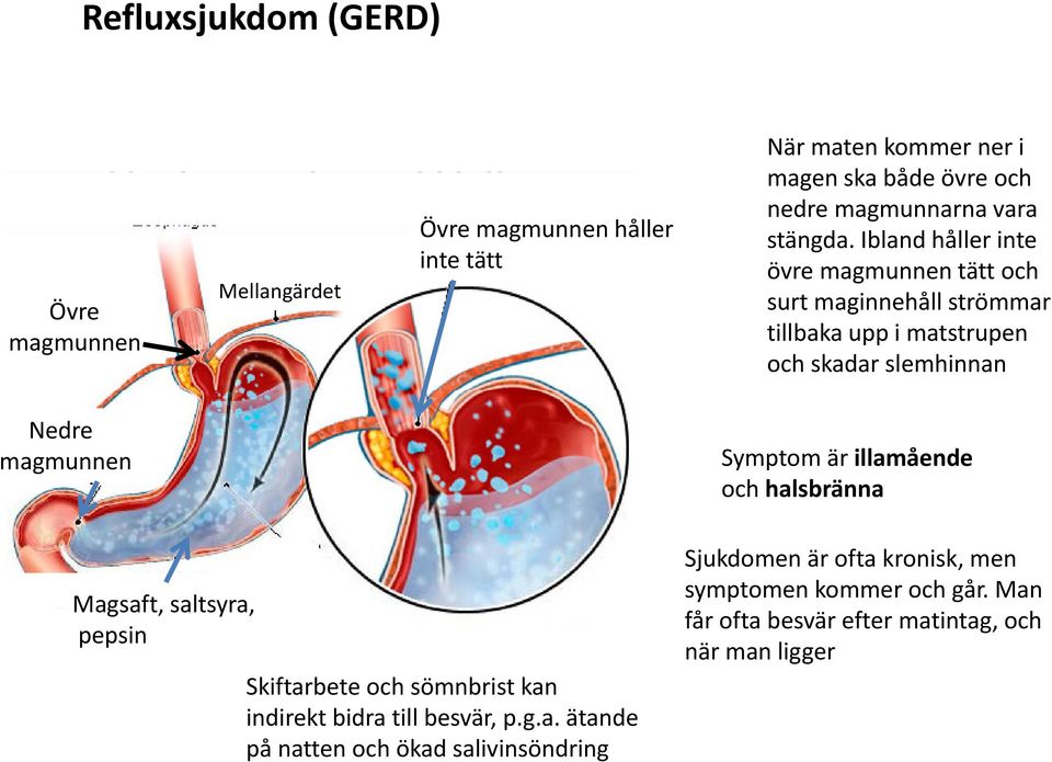 Ibland håller inte övre magmunnen tätt och surt maginnehåll strömmar tillbaka upp i matstrupen och skadar slemhinnan Nedre magmunnen Symptom är