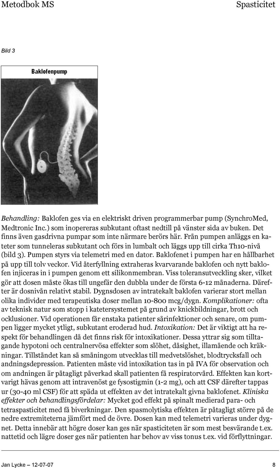 Pumpen styrs via telemetri med en dator. Baklofenet i pumpen har en hållbarhet på upp till tolv veckor.