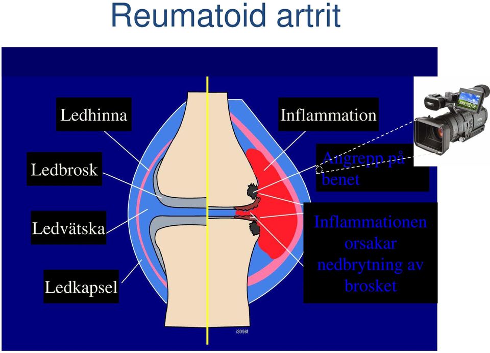 Inflammation Angrepp på benet