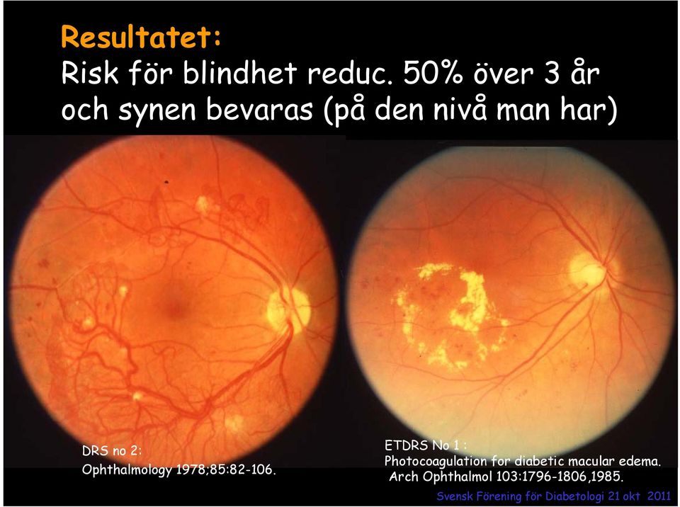 DRS no 2: Ophthalmology 1978;85:82-106.