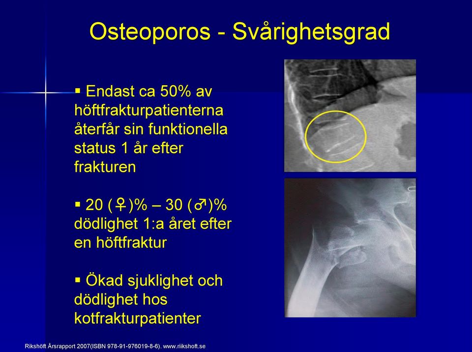 dödlighet 1:a året efter en höftfraktur Ökad sjuklighet och dödlighet hos