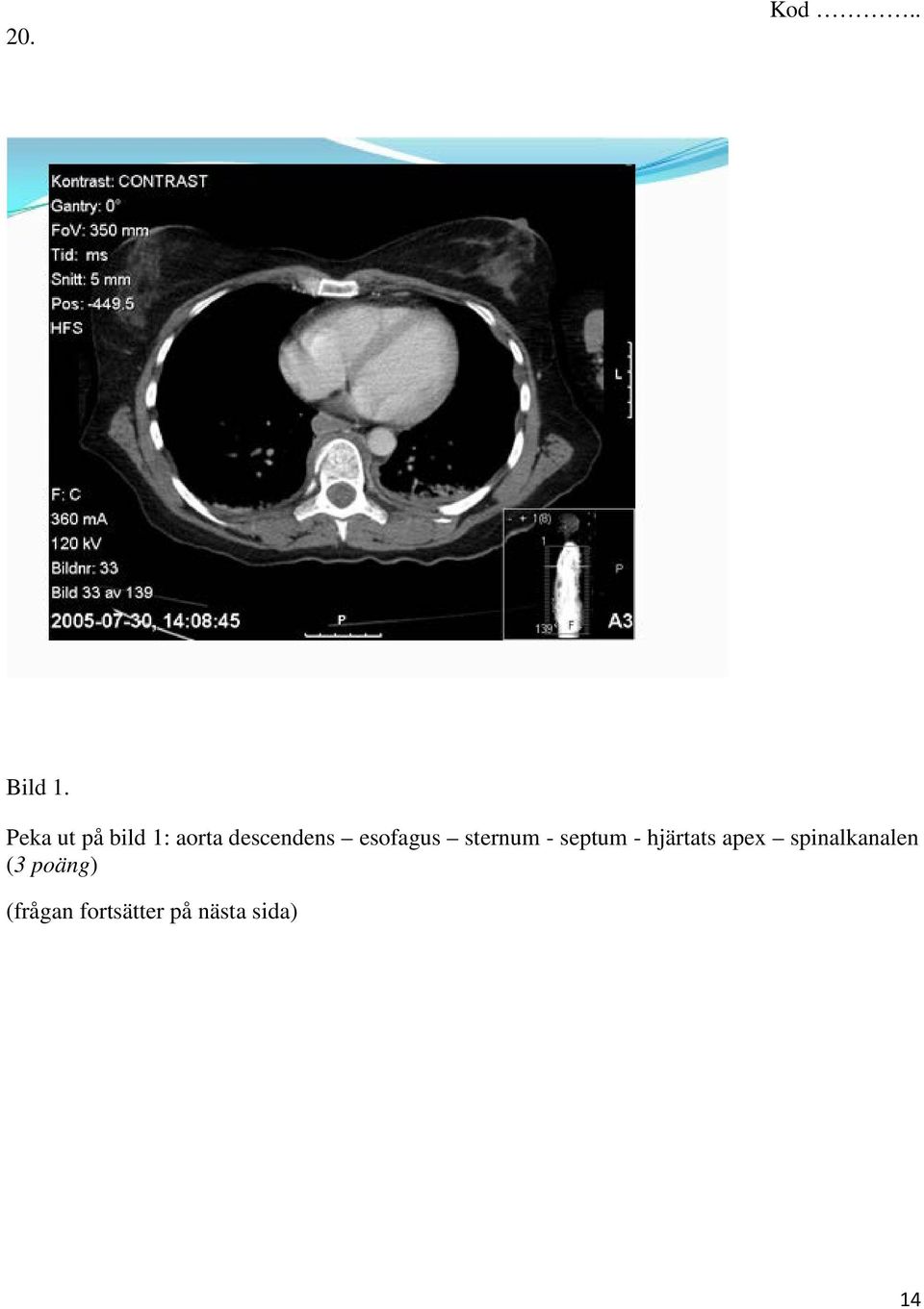 esofagus sternum - septum - hjärtats