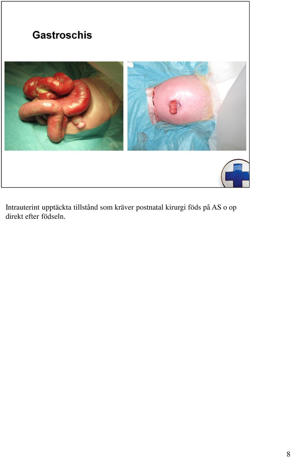 postnatal kirurgi föds på