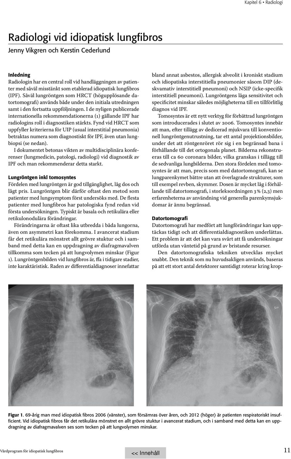 I de nyligen publicerade internationella rekommendationerna (1) gällande IPF har radiologins roll i diagnostiken stärkts.