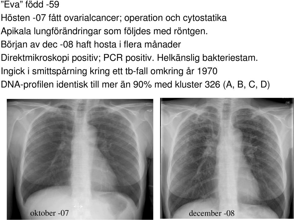 Början av dec -08 haft hosta i flera månader Direktmikroskopi positiv; PCR positiv.