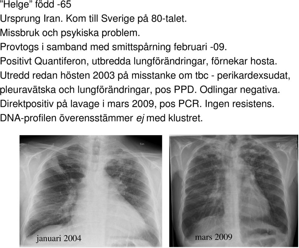 Utredd redan hösten 2003 på misstanke om tbc - perikardexsudat, pleuravätska och lungförändringar, pos PPD.