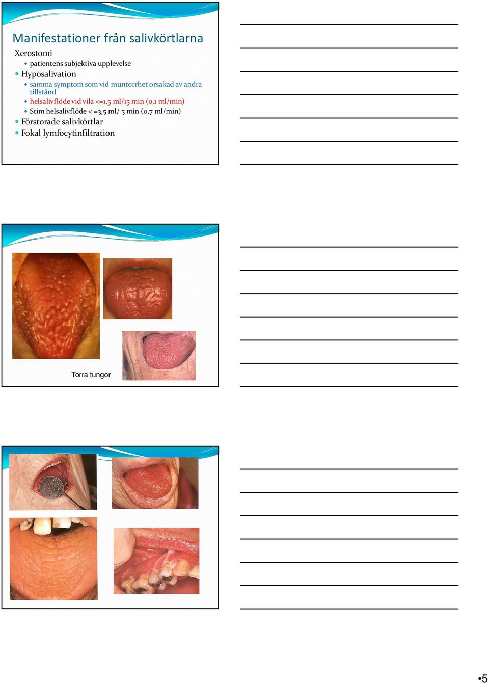 helsalivflöde vid vila <=1,5 ml/15 min (0,1 ml/min) Stim helsalivflöde < =3,5