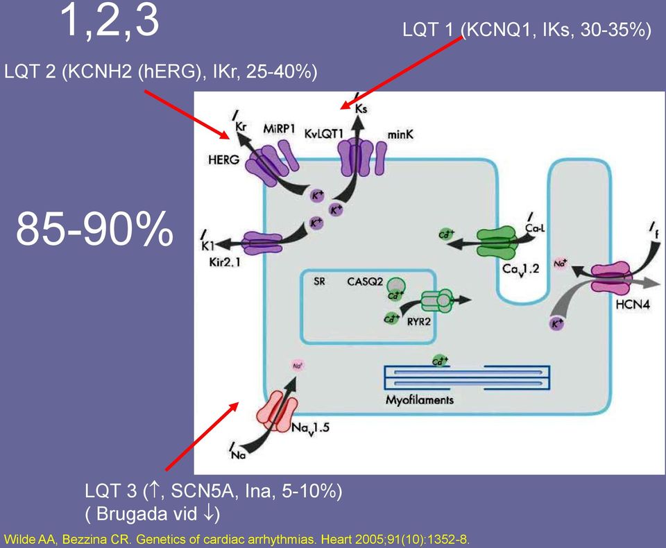 5-10%) ( Brugada vid ) Wilde AA, Bezzina CR.