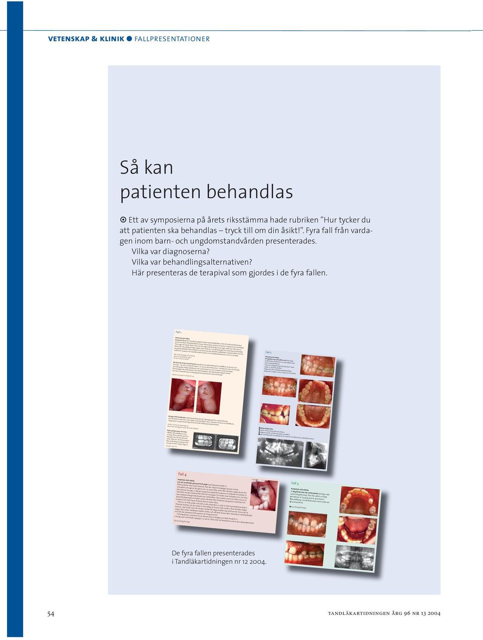 8-årig flicka som haft diffus värk från höger ansiktshalva. Flickan har ett neutralbett men med uttalad platsbrist. Anterior tvångsförning, kan bita kant i kant. Aplasi 15. Fistel buckalt 85.