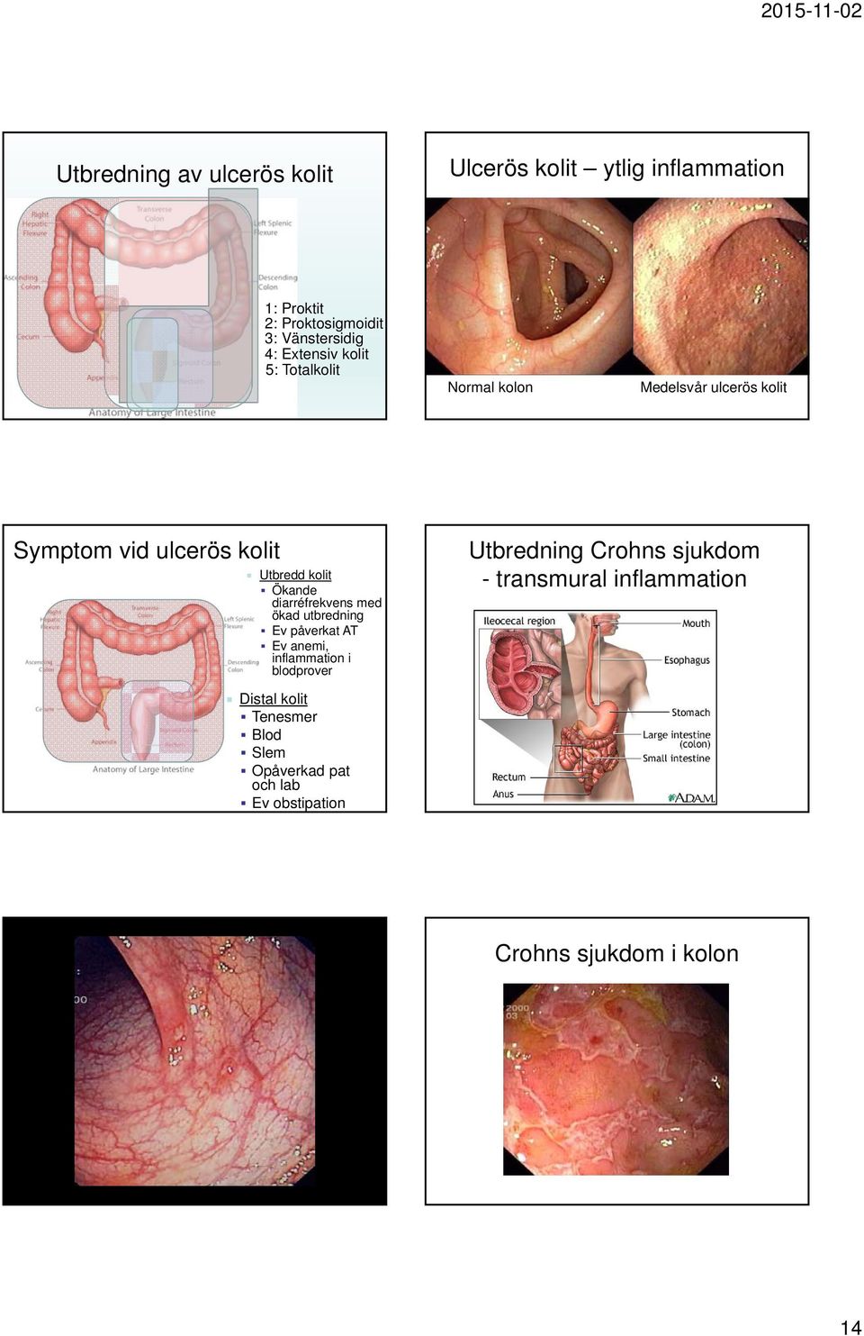 diarréfrekvens med ökad utbredning Ev påverkat AT Ev anemi, inflammation i blodprover Utbredning Crohns sjukdom -