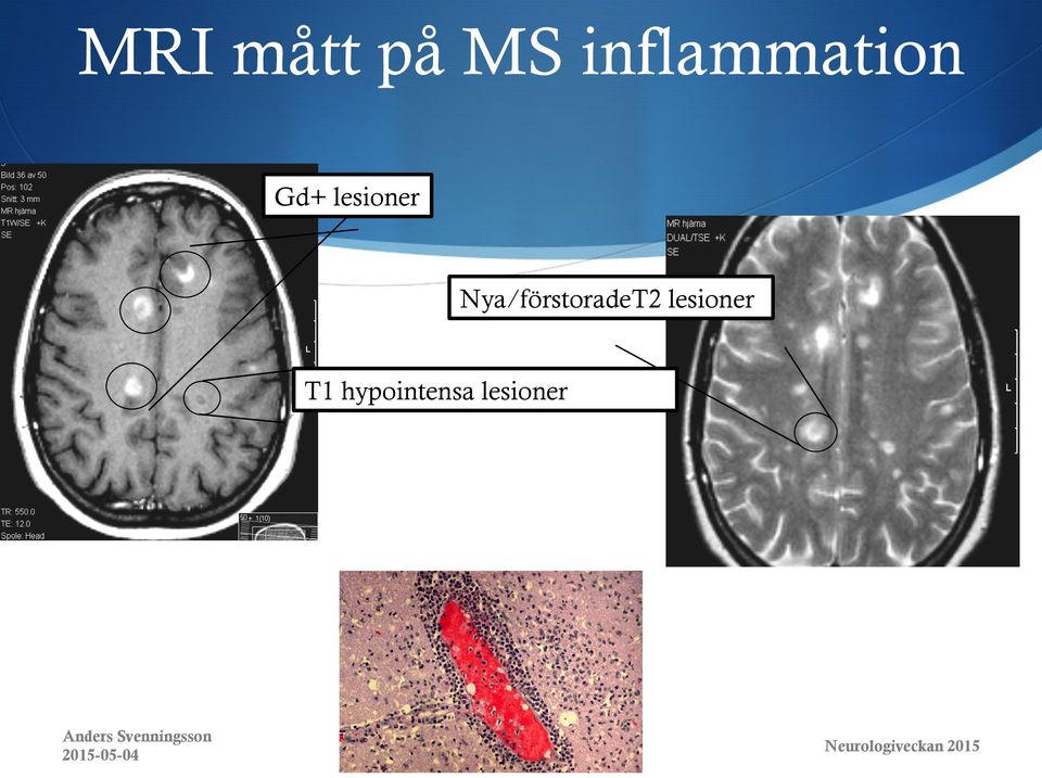 T1 hypointensa lesioner Anders