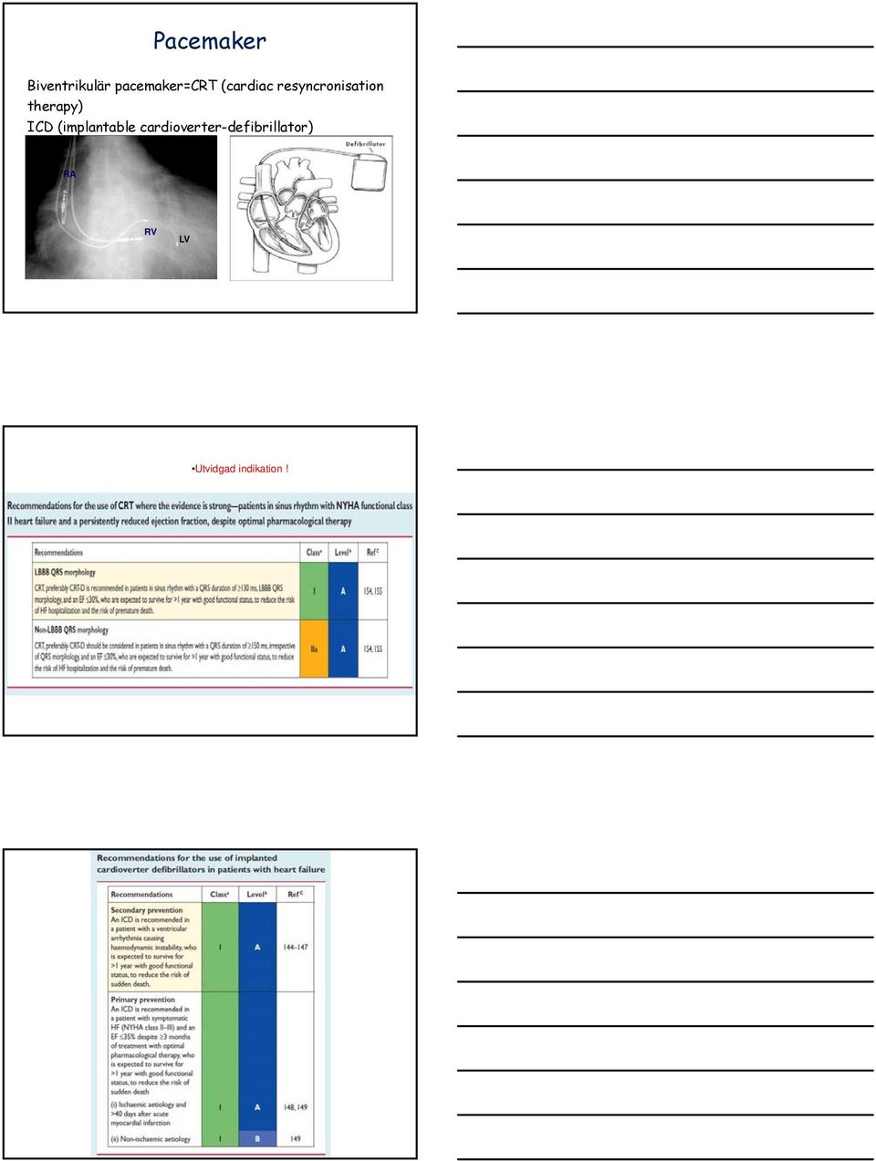 ICD (implantable