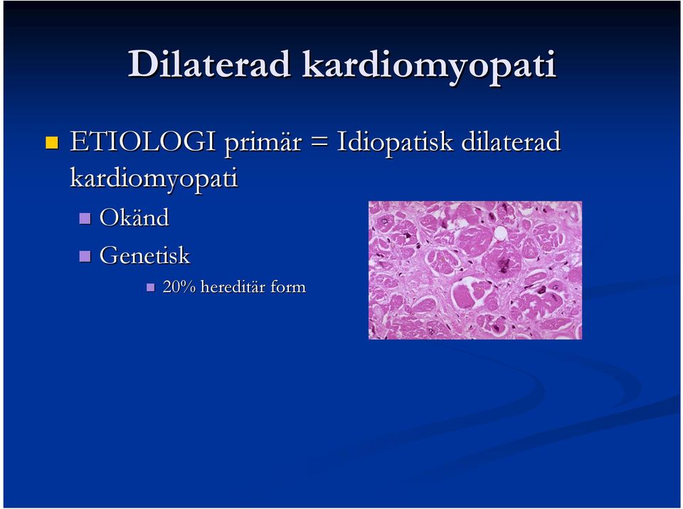 Idiopatisk dilaterad