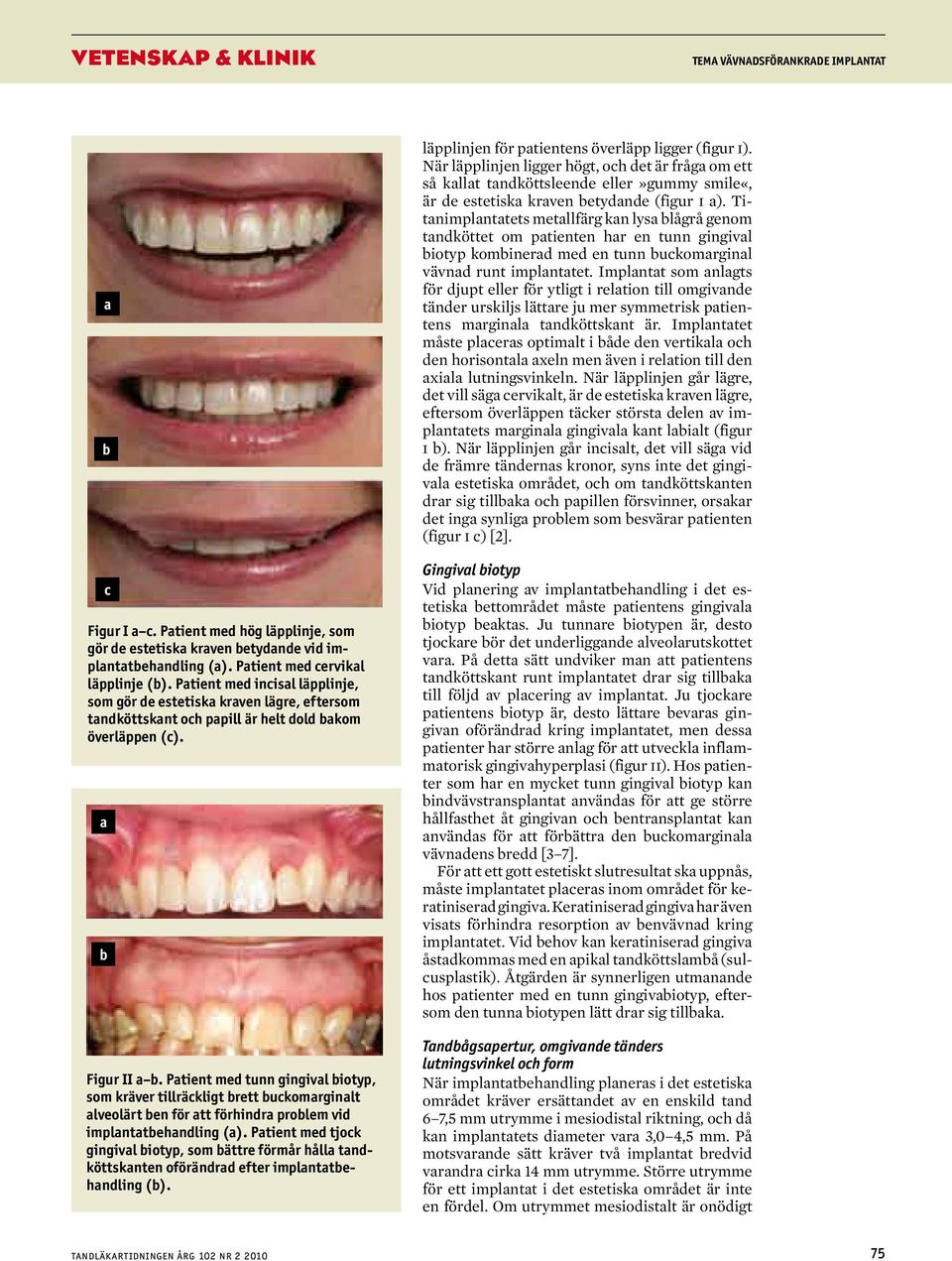 Patient med tunn gingival biotyp, som kräver tillräckligt brett buckomarginalt alveolärt ben för att förhindra problem vid implantatbehandling (a).