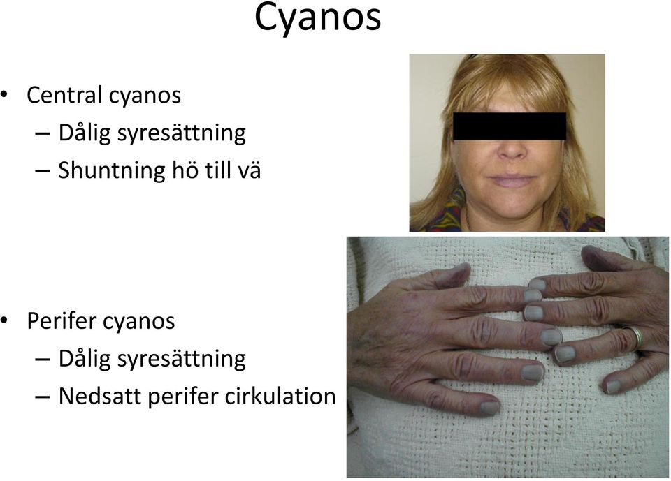 vä Perifer cyanos Dålig