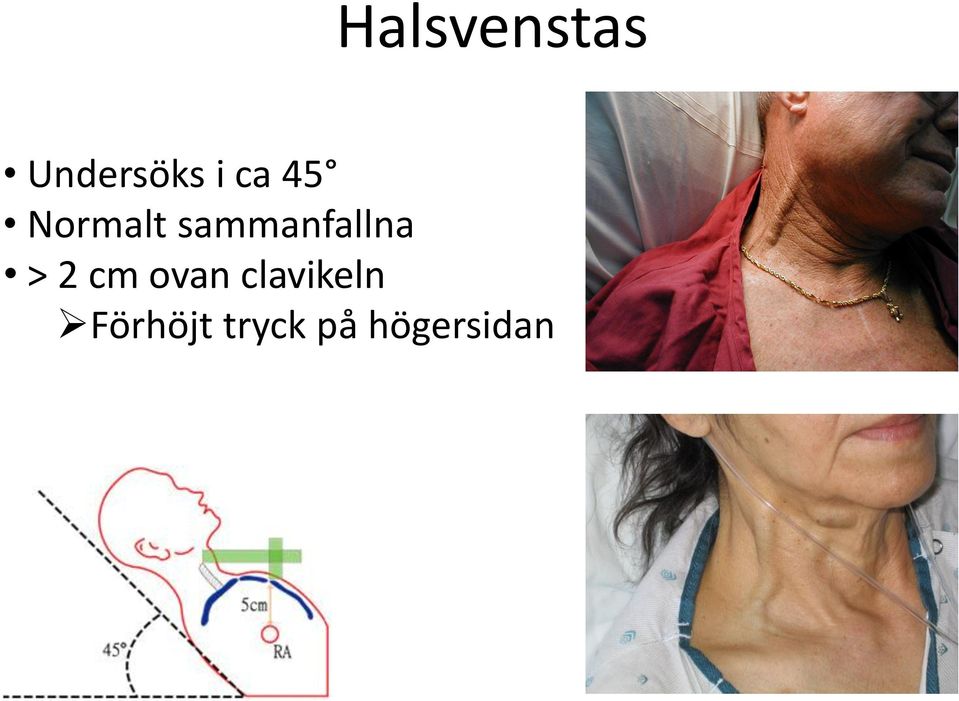 sammanfallna > 2 cm ovan