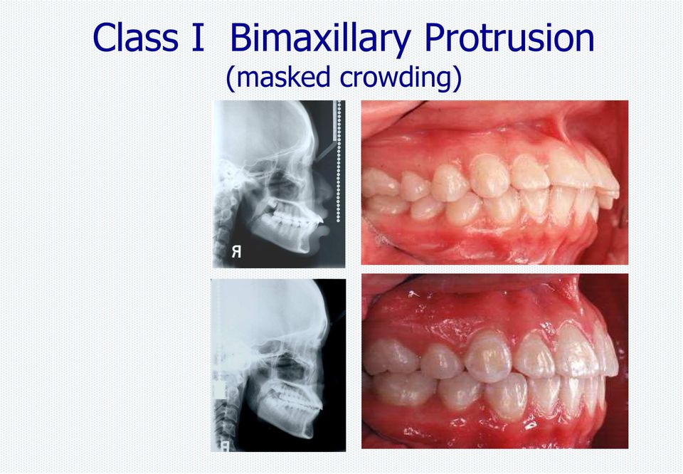 Protrusion