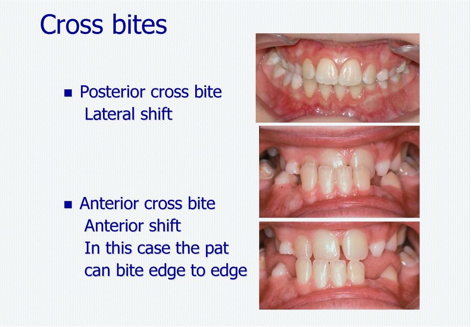 cross bite Anterior shift In