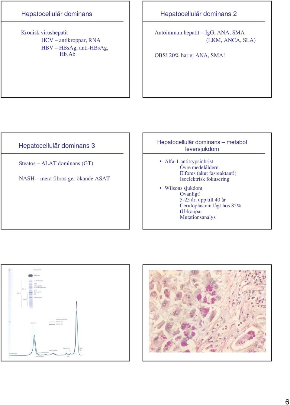 Hepatocellulär dominans 3 Steatos ALAT dominans (GT) NASH mera fibros ger ökande ASAT Hepatocellulär dominans metabol leversjukdom