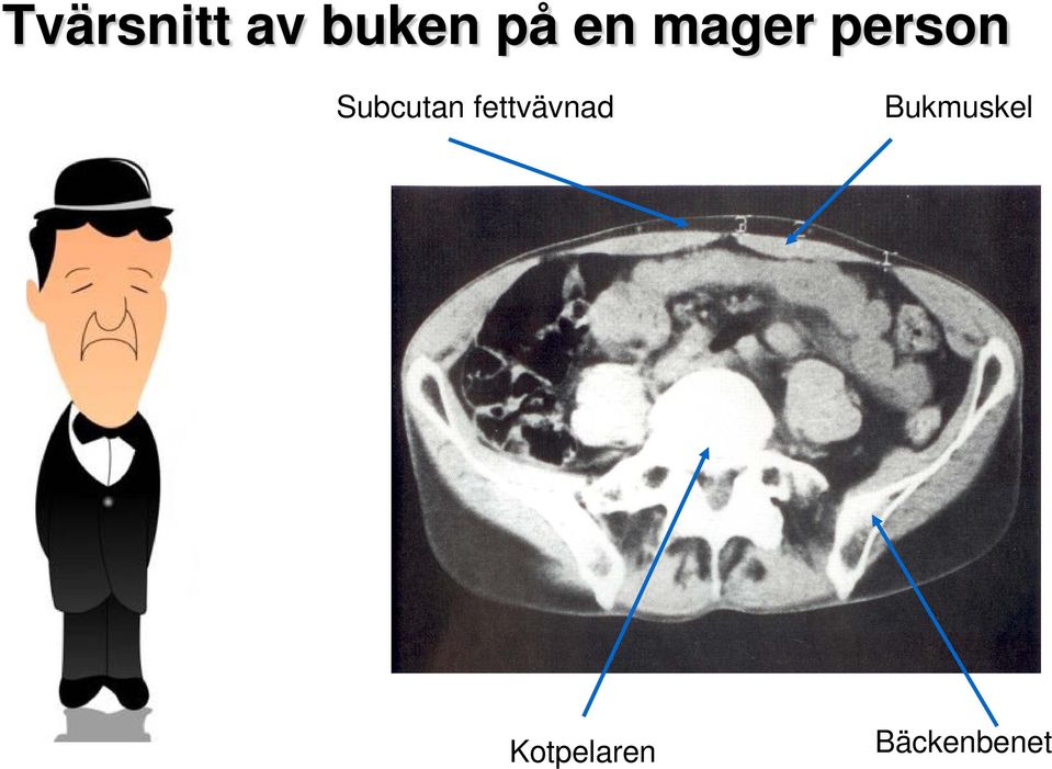 Subcutan fettvävnad