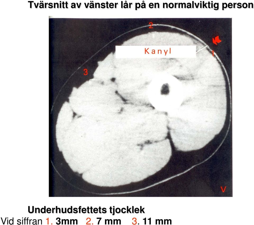 Underhudsfettets tjocklek