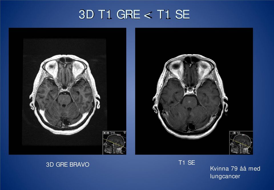 T1 SE Kvinna 79