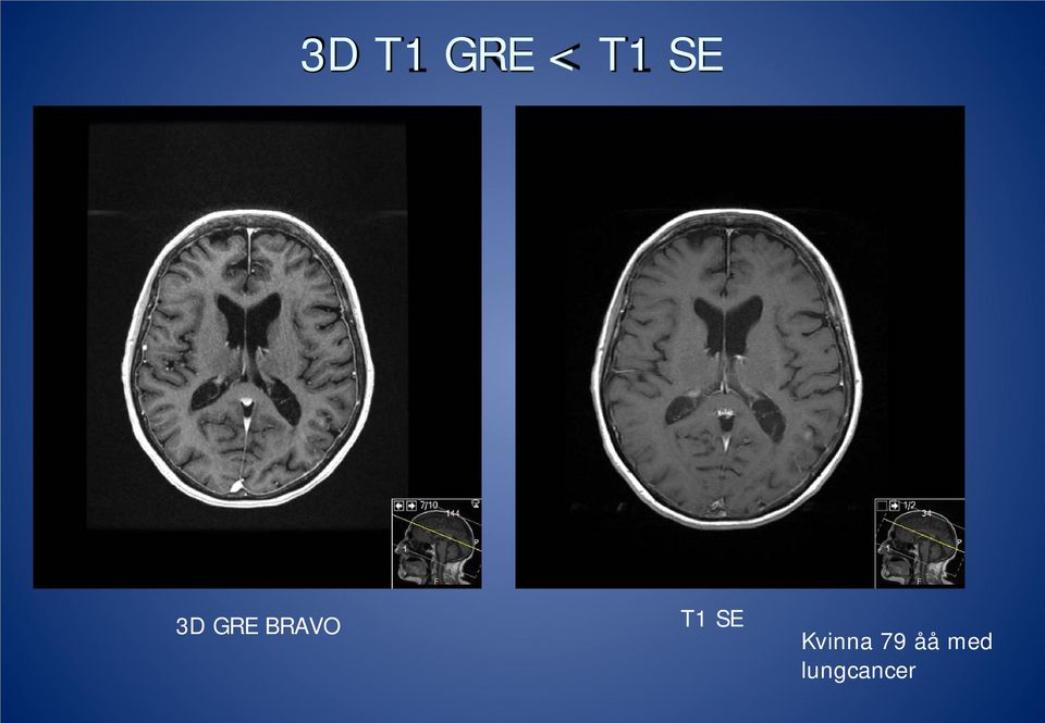 T1 SE Kvinna 79