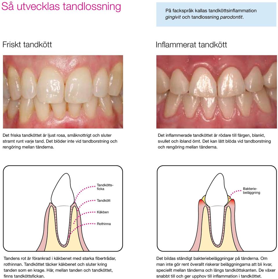 Det inflammerade tandköttet är rödare till färgen, blankt, svullet och ibland ömt. Det kan lätt blöda vid tandborstning och rengöring mellan tänderna.