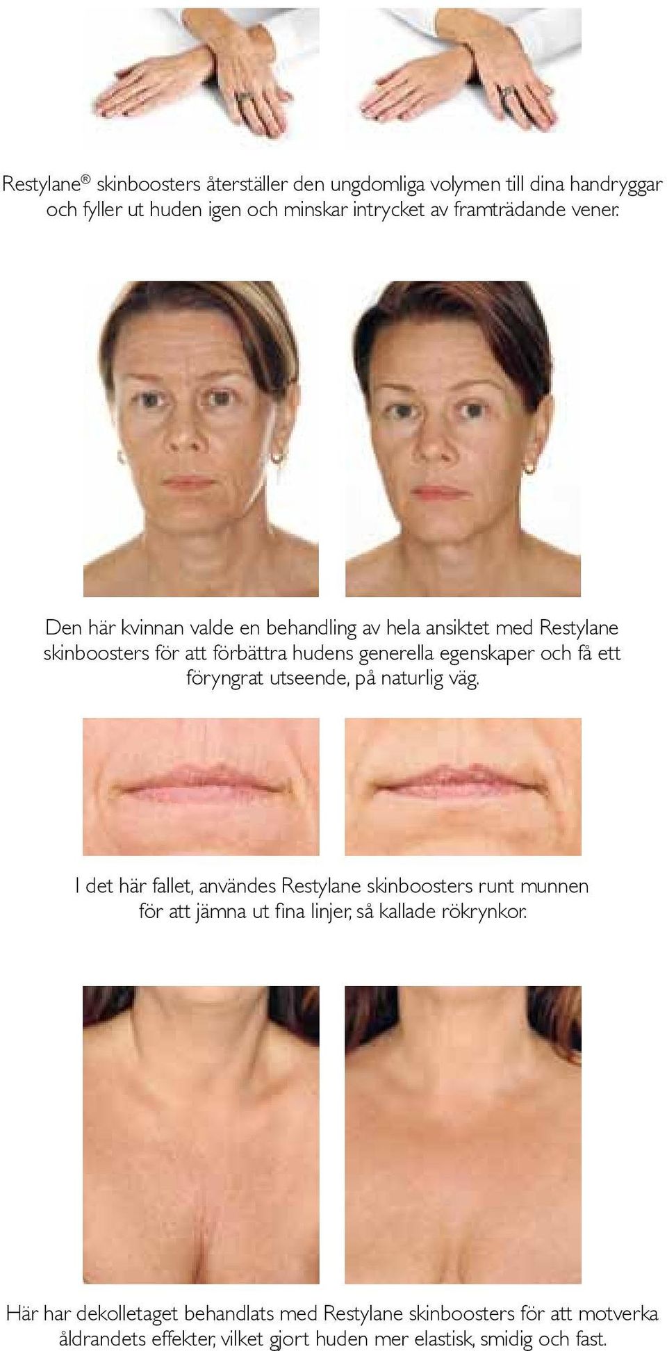 Den här kvinnan valde en behandling av hela ansiktet med Restylane skinboosters för att förbättra hudens generella egenskaper och få ett