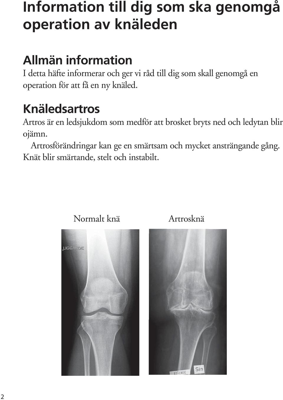 Knäledsartros Artros är en ledsjukdom som medför att brosket bryts ned och ledytan blir ojämn.